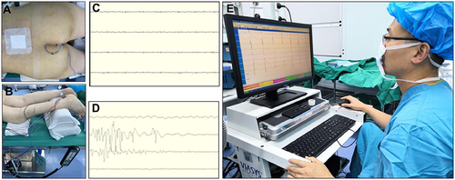 Figure 2 Intraoperative nerve monitoring. (A and B) The stimulation of cauda equina and bilateral L5 nerve roots were recorded by electrode needles that were inserted in anal sphincter and bilateral tibialis anterior and extensor digitorum longus, respectively. The detection mode was to be set to Free-EMG. (C) The normal Free-EMG should be a linear resting waveform. (D) The stimulation of the L5 nerve roots were detected. (E) The electrophysiologist was watching the Free-EMG waveform closely. All persons have provided informed consent for the images to be published. EMG indicates Electromyography.