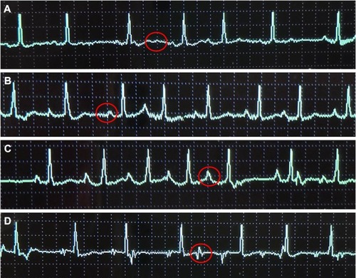 Figure 1 Change of f wave as PICC entered the lower 1/3 of SVC, CAJ, and the right atrium.