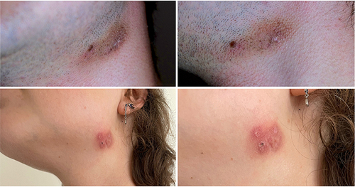 Figure 5 Variable manifestations of fiddler’s neck type 1 caused by mechanical pressure and shear stress on the submandibular skin. Upper row: secondary flat darkening of a patch of skin due to hyperpigmentation in a male violinist. Lower row: more erythematous and prominent finding with eczematous, papular and scaly thickening of the skin due to lichenification in a female violinist.