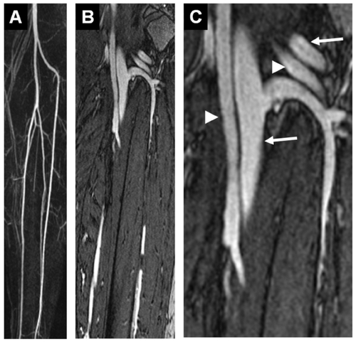 Figure 1 Gadofosveset-enhanced MRA data of a 30-year old healthy proband: after contrast agent injection and by using new multi-channel MR scanners, a MRA in dynamic or first-pass phase with purely arterial contrast can be realized for both the carotid arteries and the lower thigh arteries (A, spatial resolution: 1.0 mm3 voxel size, subtracted maximum-intensity projections (MIP), acquisition time: 29 seconds). In the following acquisition performed during the equilibrium phase, very high spatial resolutions of below 0.1 mm3 voxel size can be achieved, which, at a satisfactory signal-to-noise ratio, permit sufficient differentiation between arterial and venous vascular structures despite the small vascular diameter and the close proximity of the structures (B, C (enlarged view), 0.074 mm3 voxel size, acquisition time: 6:15 minutes, arrows: veins; arrow heads: arteries). Image: courtesy Konstantin CitationNikolaou, reproduced from Mathias Goyen (ed.). 2006. Vasovist – the first intravascular contrast agent for MR angiography. ABW-Wissenschaftsverlag Berlin.