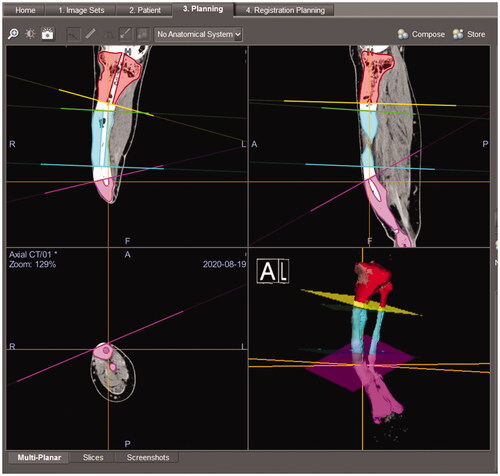 Figure 5. The screenshot of the navigation system during surgery. Osteotomy planes and post-osteotomy models showing the intramedullary nail route were superimposed on the CT image data of the patient’s tibia.