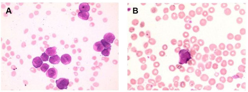 Figure 1 Circulating leukemic cells from peripheral blood smears of different patients  (A and B).