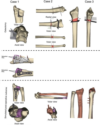 Figure 3. Results of computer-assisted planning for each patient. The top row illustrates the pre-operative planning for the correct site of the osteotomy and the degree of the necessary correction. Middle row, for case 1, the procedure of placing the reduction pins (K-wires) to ensure correct position of the distal fragment in relation to the proximal radius and plate position is displayed. The bottom row presents a virtual model after the simulated osteotomy and the plates and screws placement.