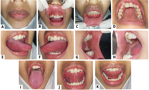 Figure 4 Patient has no complaints in the oral cavity (A–K).