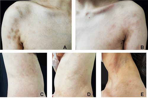 Figure 1 Scattered light brown, grayish-white patches were observed on the trunk and neck, symmetrically distributed, with poorly defined borders, and the central part of the site may show parchment-like atrophy. (A-D) Trunk; (E) Neck.