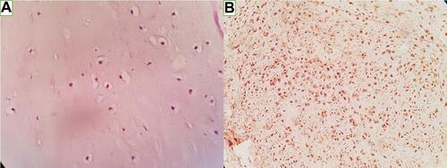 Figure 2 (A) Hematoxylin and eosin staining, 400×, showing cartilaginous lobules without atypia, mitosis, or necrosis and (B) positive IHC staining of S100 marker.