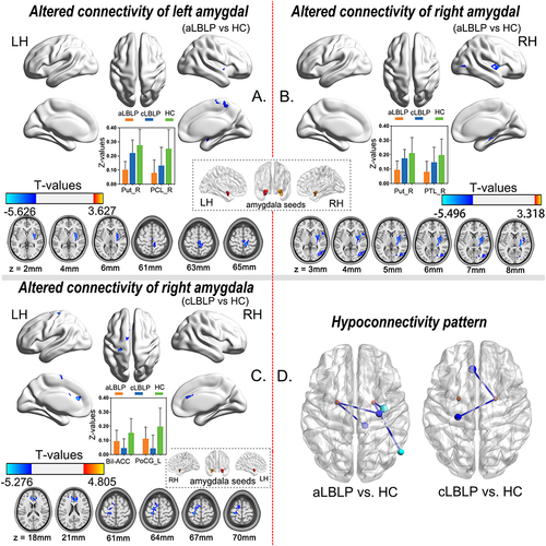 Figure 2 Altered pattern of amygdala rsFC in aLBLP and cLBLP patients (voxel-level P < 0.01, GRF correction at cluster-level P < 0.05).