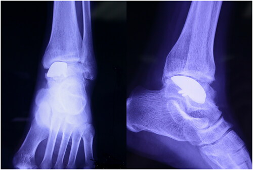 Figure 7. X-rays after 24 months.