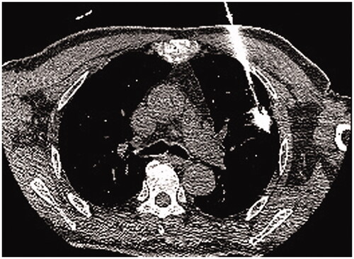 Figure 2. The puncture path of microwave ablation needle percutaneous into lung tumor.