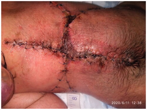 Figure 5. The repair 7 days postoperatively.