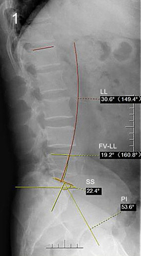 Figure 1 X-ray film showing the measuring method of preoperative LL, FV-LL, PI, SS.