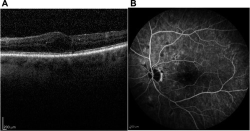 Figure 2 (A) SD-OCT scan of the same eye using the same device, 9 months after initiation of therapy. (B) Fluorescence angiography of the same eye using the same device, 9 months after initiation of therapy.