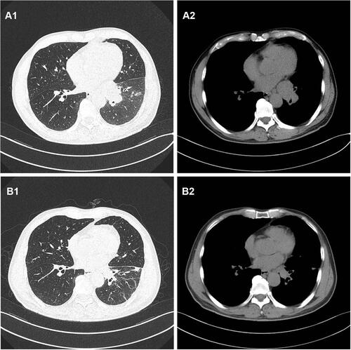 Figure 1 (A1 and A2) The baseline CT scan of the patient’s chest in August 2020. (B1 and B2) CT scan of the chest after two cycles of durvalumab in October 2020.