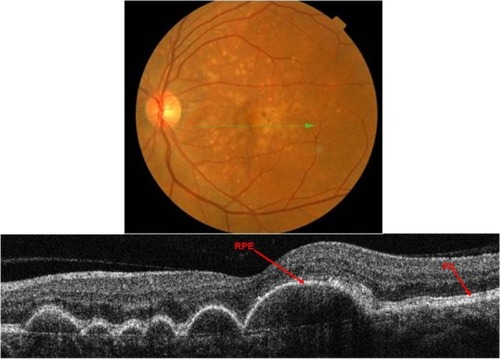 Figure 12 Fundus photograph (top) showing soft drusen in the left eye of a patient with ARMD; the B-scan line on the fundus photograph has the same width as the B-scan SD-OCT image (bottom) which demonstrates the appearance of soft drusen.