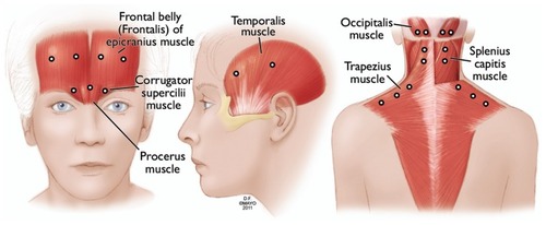 Figure 3 OnabotulinumtoxinA injection sites used by the authors (see Table 3 for dosing).