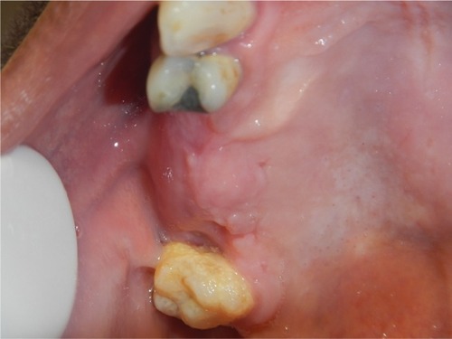 Figure 8 Six weeks after surgery, complete wound healing with obvious hypertrophy of the soft tissue was observed.