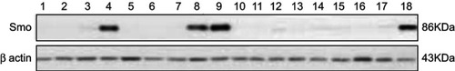 Figure 3 Western blot analysis of Smo protein expression in 18 available samples for protein analysis. Numbers 1–9, 17, and 18=Samples of patients with multidrug resistance (MDR), Numbers 10–16=Samples of sensitive patients to chemotherapy (MRD-).