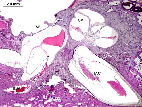 Figure 1. An IP-II cochlea with scala vestibuli (SV) dilatation, in case of EVA (SF = Stapes footplate, IAC = internal auditory canal) (with permission of Department of Otolaryngology of Massachusetts Eye and Ear Infirmary and Cochlear Implants International).
