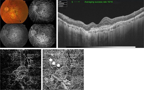 Figure 3 Upper left, color photo and FFA of the left eye of a 75-year-old female with scarred CNV secondary to AMD. Upper right, corresponding SS-OCT image in radial scan mode shows marked disorganization of the outer retina with marked thinning of the RPE and choriocapillaris. No intra-retinal fluid is discernible. Lower, “en face” SS-OCTA image of the same eye taken at the level of the outer retina (left) and the choriocapillaris (right) in a 6×6 mm field. The entire lesion complex is composed mostly of large mature vessels that yield hyperintense signal with intervening hollowness due to absent capillaries. A single large feeder vessel is shown supplying the main lesion (closed arrow heads). The shadow of the large choroidal vessel (open arrow head) is shown.