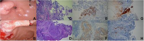 Figure 3 EGD (A and B), HE (C and D) and IHC (E–H) results for the patient. (A and B) EGD showed a large irregular lump at the gastric antrum (A) and a deeply ulcerating mass at the duodenum bulb (B). (C and D) H&E staining results for the tumor residing in the gastric antrum and duodenum. (E and F) SALL4 staining results for gastric antrum (E) and duodenum (F). (G and H) AFP staining results for gastric antrum (G) and duodenum (H).