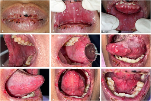 Figure 1 The clinical condition of the patient at the first visit: (A) serosanguinolent crusts on the lips, an erosive area on the right corner of the mouth that tended to bleed; (B–I) white ulcers with yellowish edges, irregular in shape, and varied in sizes on the labial, buccal, lateral, and ventral mucosa of the tongue, and the floor of the mouth.