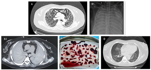 Figure 1 (A) Chest CT on hospital day 28 showing diffuse opacities in the lung fields and exacerbation of mediastinal emphysema. (B1) Chest x-ray showing bilateral consolidation. (B2) Chest CT showing bilateral consolidation and haemothorax. (C) Blood clots removed from the airways using a fibreoptic bronchoscope. (D) Chest CT on hospital day 163 showed that the opacity of both lungs disappeared and slight ground-glass changes.