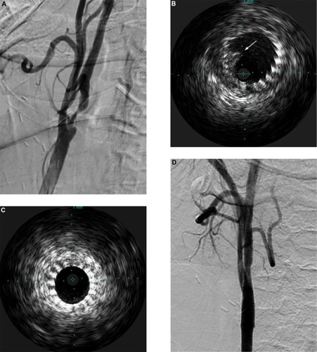 Figure 2 Case illustration of the utility of intravascular ultrasound (IVUS).