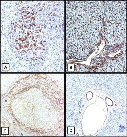 Figure 2 Immunohistochemical localization of TGFβ1 protein in human BA. Specific staining of TGFβ1 protein is represented by brown coloration. A) The expression of TGFβ1 in BA, which is mostly in lobular areas. B) TGFβ1 expression in a liver used as control. C) Expression of α1-SMA in BA. D) α1-SMA from a liver used as control (original magnification ×10).