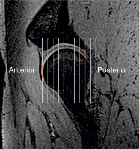 Figure 16. Method 2: On the sagittal images of the hip joint, every third image per series was sampled which added up to four to five images. A grid of approximately 15 vertical test lines was selected and superimposed on the images, and where the test lines intercepted the cartilage, the distance following the direction of the test line through the cartilage was manually measured. The approximately 6080 measured distances were summed (Citation86), and the mean thickness of the acetabular and femoral cartilage was calculated.