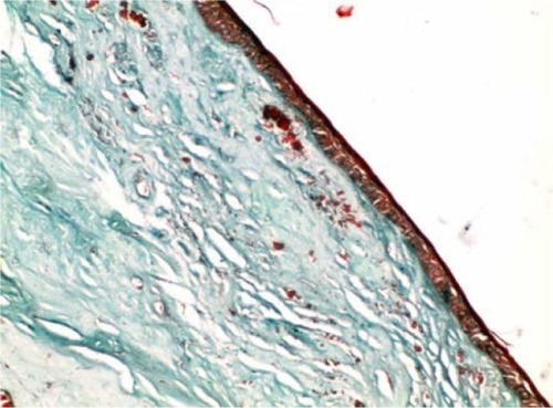 Figure 8 A photomicrograph of treated pterygium section showing the collagen fibers that are regularly arranged close to each other with no signs of degeneration.