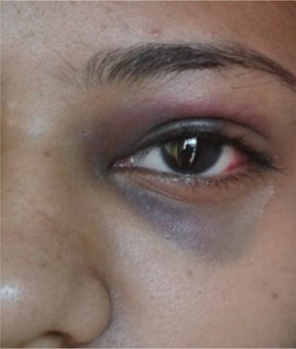 Figure 1 Initial presentation with subconjunctival hemorrhage and periorbital ecchymosis.