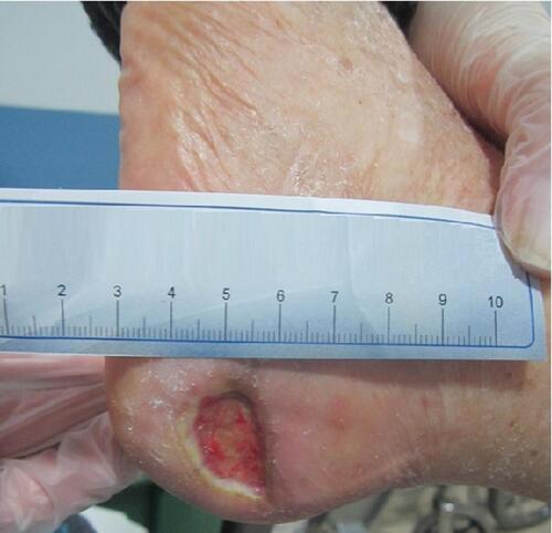 Figure 1 Injury at the beginning of the study day 0.