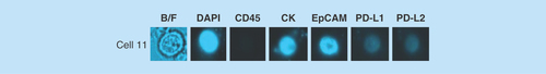 Figure 5.  Example images of a circulating tumor cell isolated from a breast cancer patient.Blood from the patient was processed for CTC enrichment using the ClearCell® FX system. The sample was then analyzed by chipcytometry and a single CTC determined to be PD-L1/PD-L2 negative was detected.CTC: Circulating tumor cell.