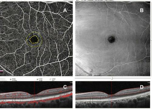 Figure 2 Optical coherence tomography angiography (A), en face (B) and cross-sectional B-scan with segmentation and angio overlay (C and D) images of the left eye of the same patient preoperatively showing the FAZ area.