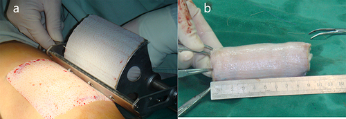 Figure 2 The surgical procedure of vaginal reconstruction for patients with MRKHS using skin graft. (a) Skin graft harvest. (b) Shape the skin graft into a cylinder.