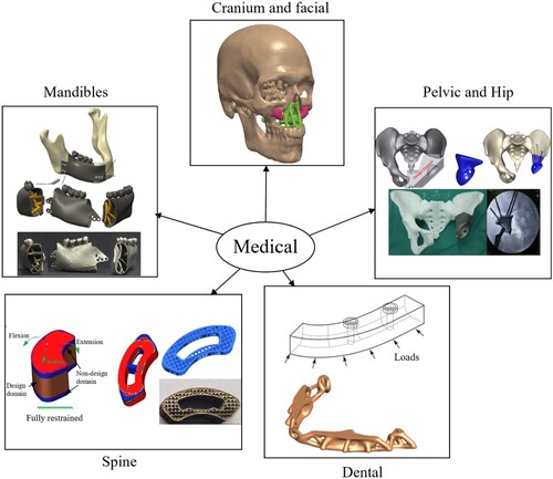 Figure 4. Major applications of TO and MAM in medicine: mandibles (reproduced with permission from Ref. (Li et al. Citation2020a). Copyright 2020, Elsevier), cranium and facial (Park et al. Citation2021), pelvic and hip (reproduced with permission from Ref. (Iqbal et al. Citation2019). Copyright 2019, Elsevier), dental (reproduced with permission from Ref. (Park et al. Citation2019). Copyright 2019, Elsevier), and spine (reproduced with permission from Ref. (Wang et al. Citation2020a). Copyright 2020, Elsevier).