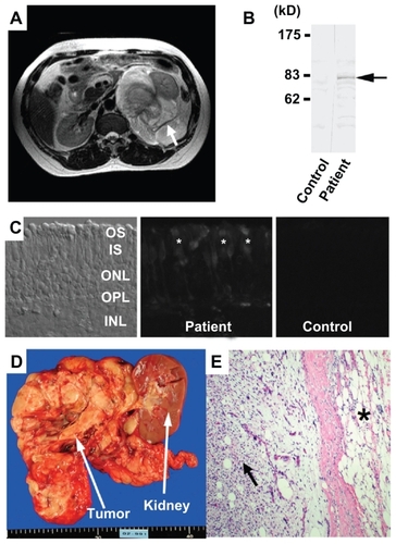 Figure 2 Systemic and histologic findings in a case of paraneoplastic retinopathy. A) Abdominal MRI showing a large retroperitoneal mass (arrow), which compressed the left kidney. B) Western blot analysis of patient’s serum using bovine retinal protein. The serum reacted to an 83 kD antigen (arrow). C) Immunohistochemical analysis using patient’s serum demonstrates autoreactivity against the photoreceptors of bovine retina. D) Gross appearance of tumor. E) Microscopic appearance of retroperitoneal tumor (× 20). Two characteristic patterns of well differentiated liposarcoma (asterisk) and dedifferentiated fibrotic sarcomatoid tissue (arrow) can be seen.