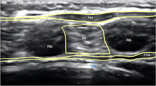 Figure 2 Deep parasternal nerve block anatomy visualized with high-frequency linear probe prior to injection, showing respectively the pectoralis muscle (PM), intercostal muscle (IM), transversus thoracic plane (TTP), and transversus thoracic muscle (TTM).