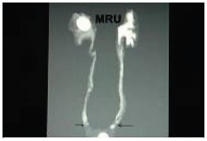 Figure 1 Magnetic resonance urogram (MRU) showing bilateral ureteric obstruction.