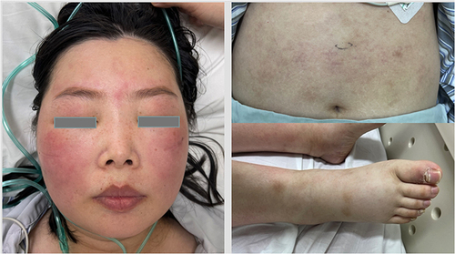 Figure 1 Clinical presentation of cytophagic histiocytic panniculitis lesions. (A) Symmetric edematous erythematous plaque on cheeks; (B and C) Subcutaneous nodules and edema on abdomen and legs.