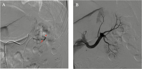 Figure 4 (A and B) DSA for the third time showing the presence of the pseudoaneurysm. (A) Showing the appearance of pseudoaneurysm (red arrows). (B) Showing the disappearance of the pseudoaneurysm after SRAE.