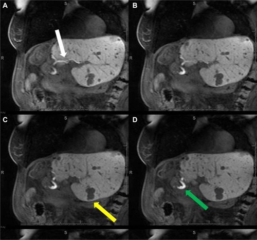 Figure 8 MRCP with Gd-EOB-DTPA.