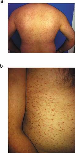 Figure 1. (a) Urticaria pigmentosa (back and both arms). (b) Urticaria pigmentosa (abdomen and right arm)