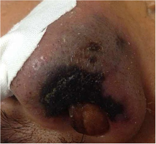 Figure 1 The left nasal alar revealed purple and swollen.