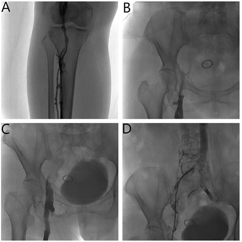 Figure 2 Radiographic image before thrombolysis. (A) Popliteal vein thrombosis. (B and C) Iliac vein occlusion. (D) Guide wire recanalization angiography showed numerous thrombi in the iliac vein.