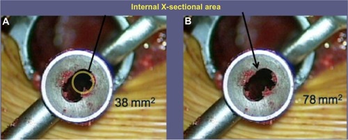 Figure 4 View of the cross section of the bone graft delivery tool relative to the conventional cylindrical tool.