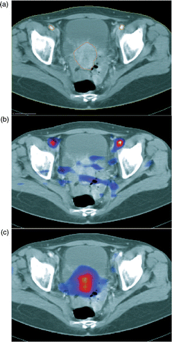 Figure 3. (a) Segmentation of common iliac artery and tumor in the CT. (b) Overlay of the bolus PET image averaged over 12 s on the fused CT. (c) Overlay PET image averaged over the total dynamic scan on the fused CT.