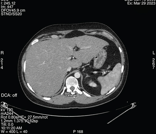 Figure 1. Abdominal CT scan showing a diffuse nodular hepatic infiltration.