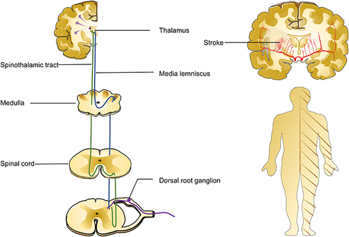 Figure 1 Anatomical schematic diagram of the sensory pathway (left). After stroke, the body corresponds to the possible range of CPSP (right).