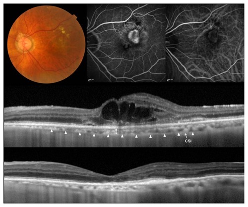 Figure 1 Choroidal neovascularization (CNV) associated with age-related macular degeneration treated with ranibizumab.